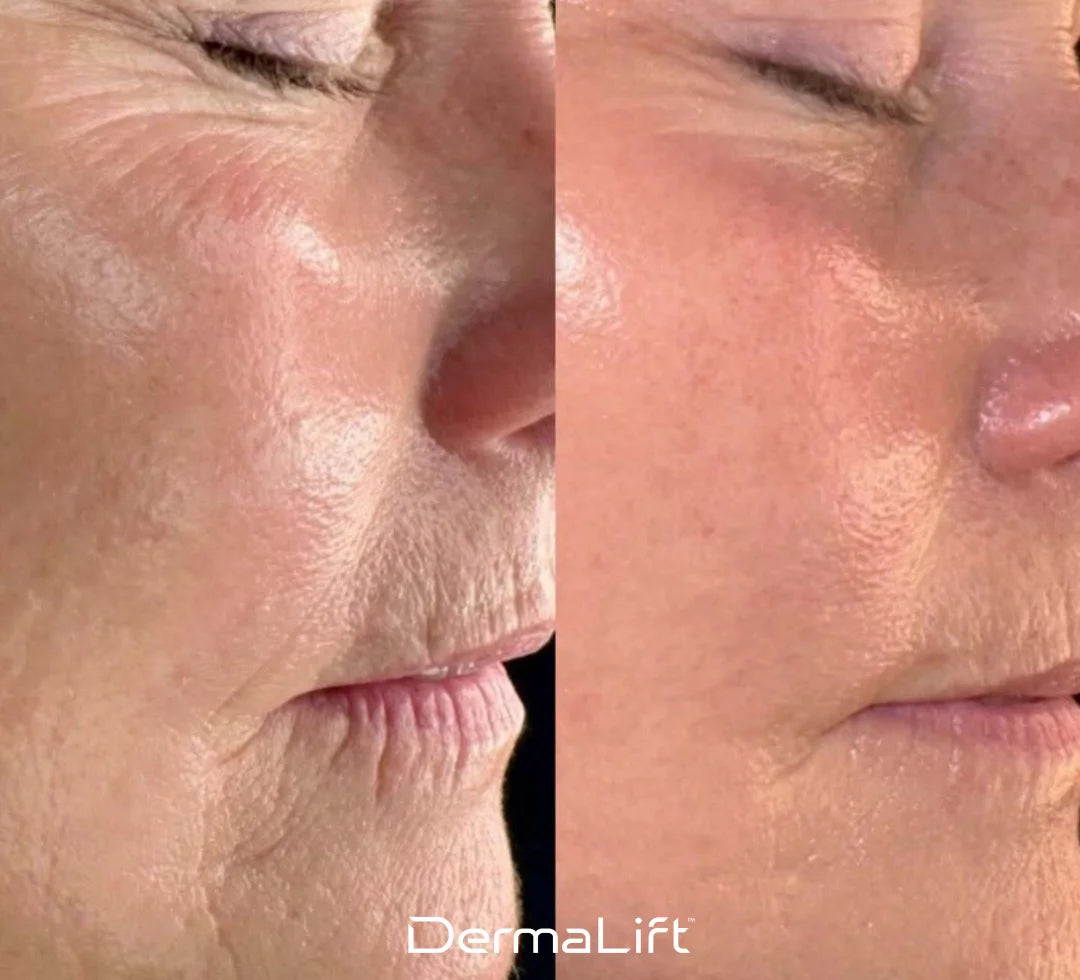 Nolyvia™ Advanced Skin-Lifting Technology