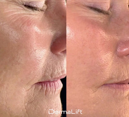 Nolyvia™ Advanced Skin-Lifting Technology