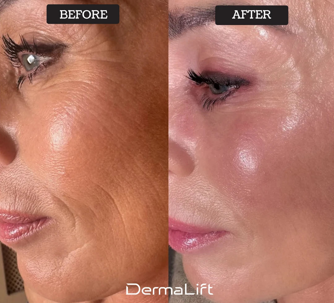 Nolyvia™ Advanced Skin-Lifting Technology