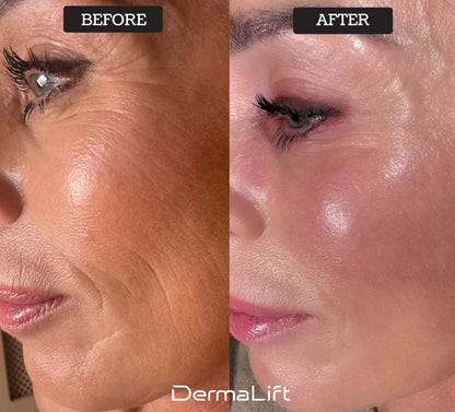 Nolyvia™ Advanced Skin-Lifting Technology